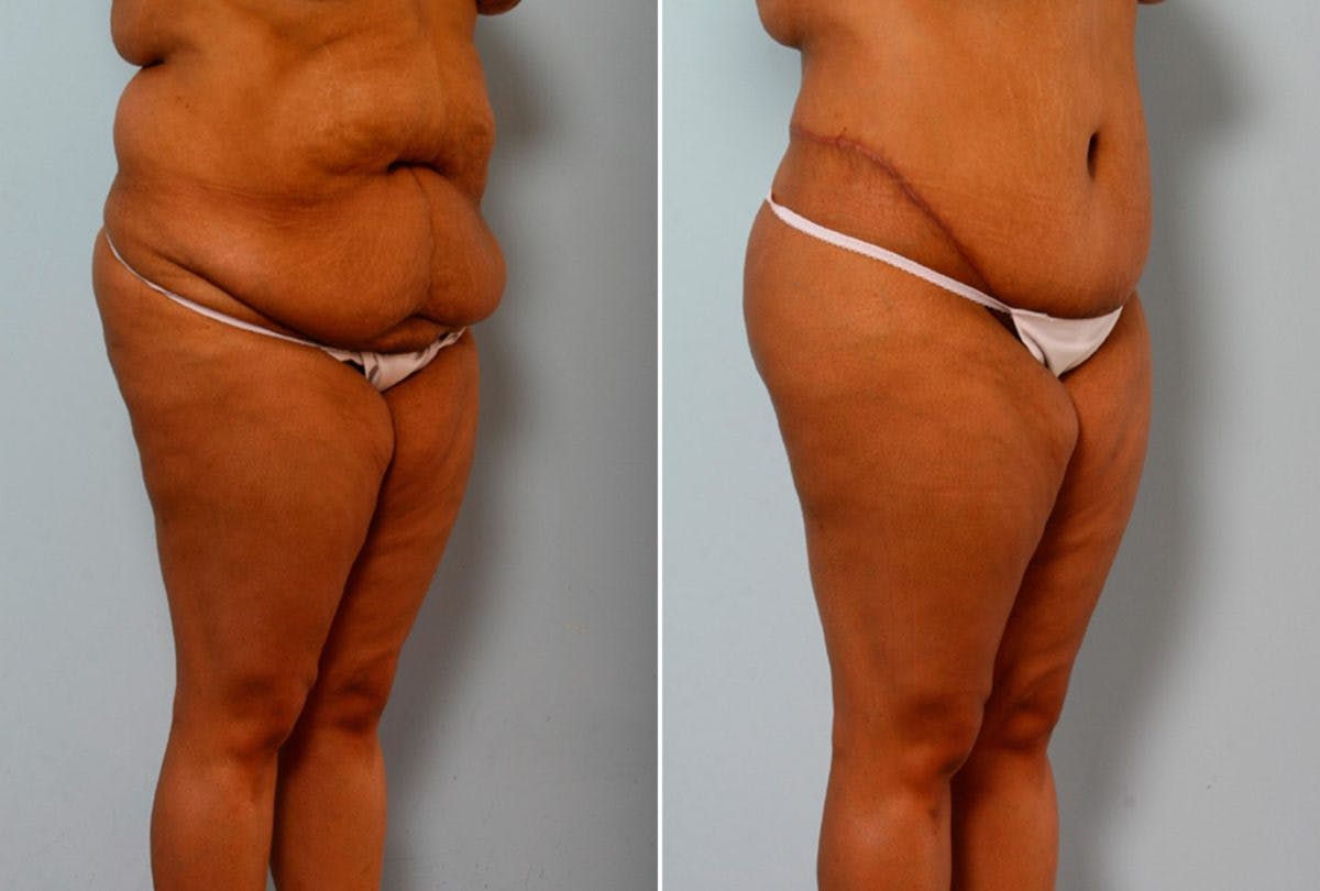 Body Lift Before & After Photo - Patient 54881927 - Image 2