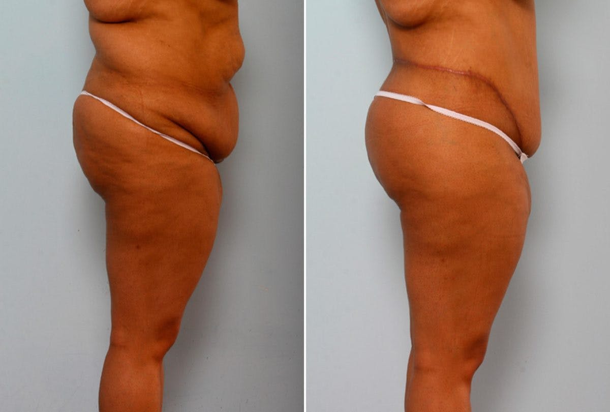 Body Lift Before & After Photo - Patient 54881927 - Image 3