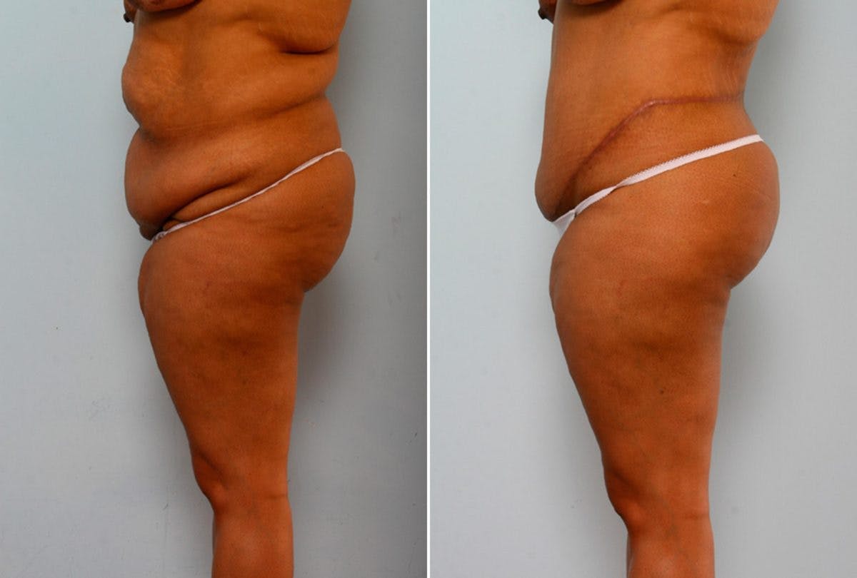 Body Lift Before & After Gallery - Patient 54881927 - Image 5