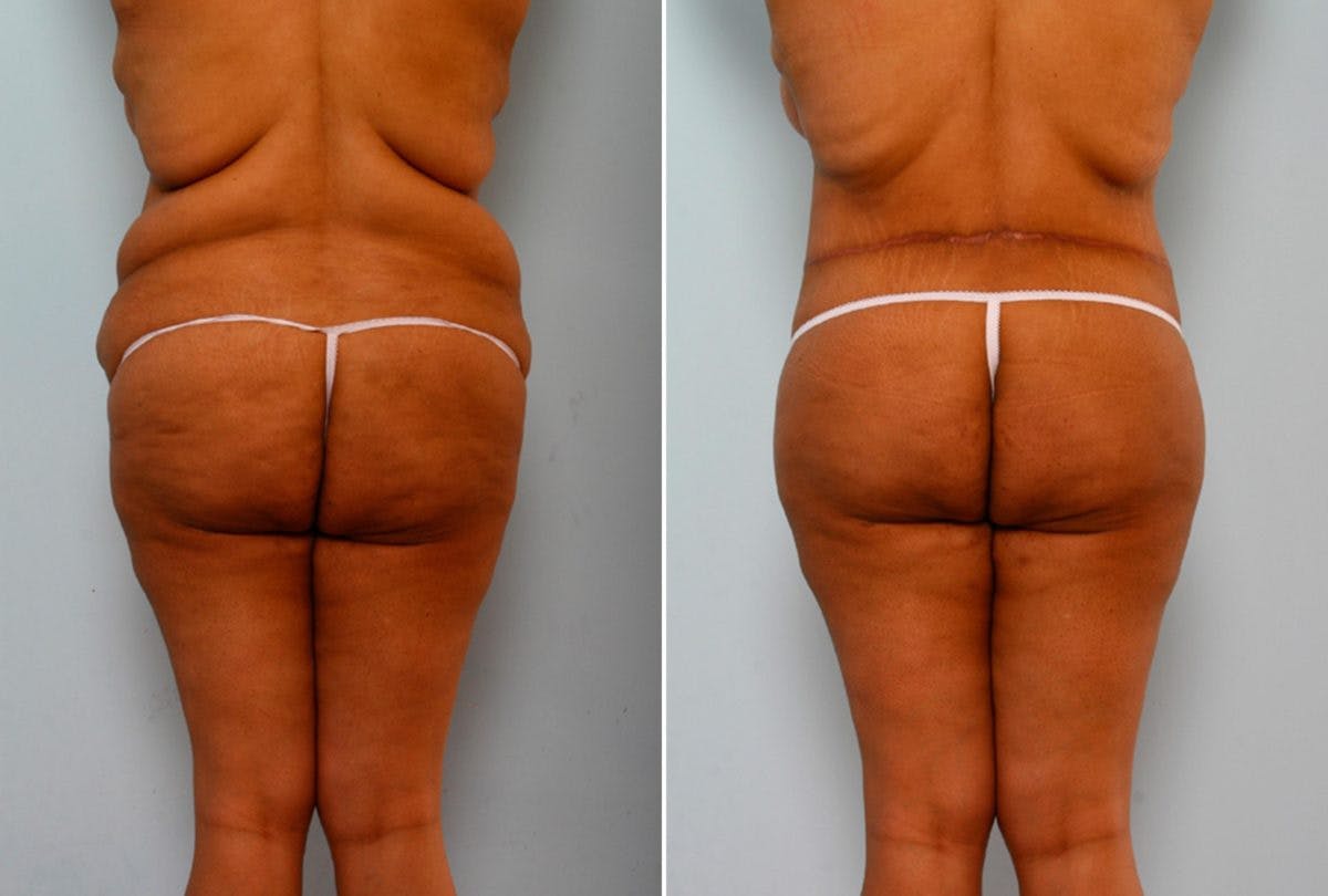 Body Lift Before & After Photo - Patient 54881927 - Image 6
