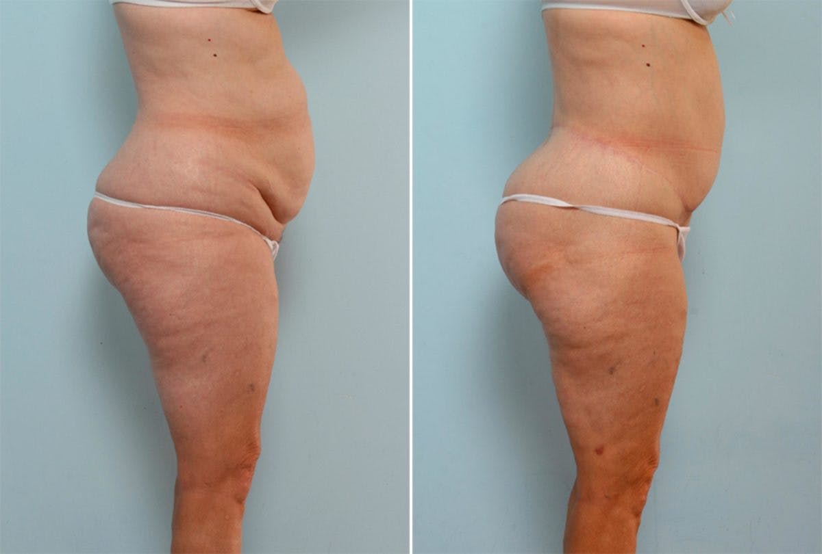 Body Lift Before & After Photo - Patient 54881929 - Image 2