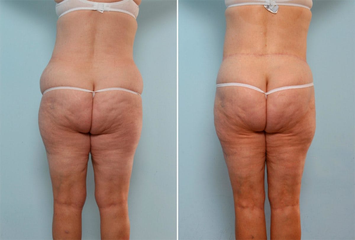 Body Lift Before & After Gallery - Patient 54881929 - Image 3