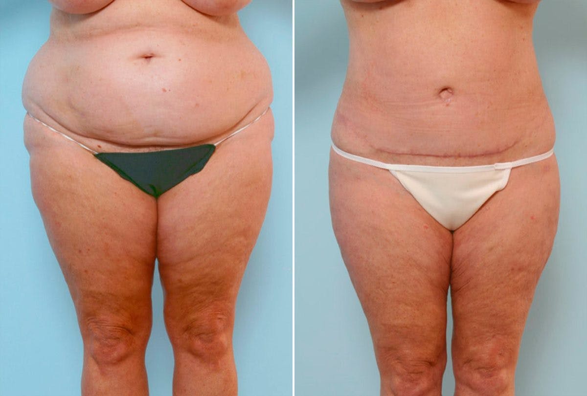 Body Lift Before & After Gallery - Patient 54881936 - Image 1
