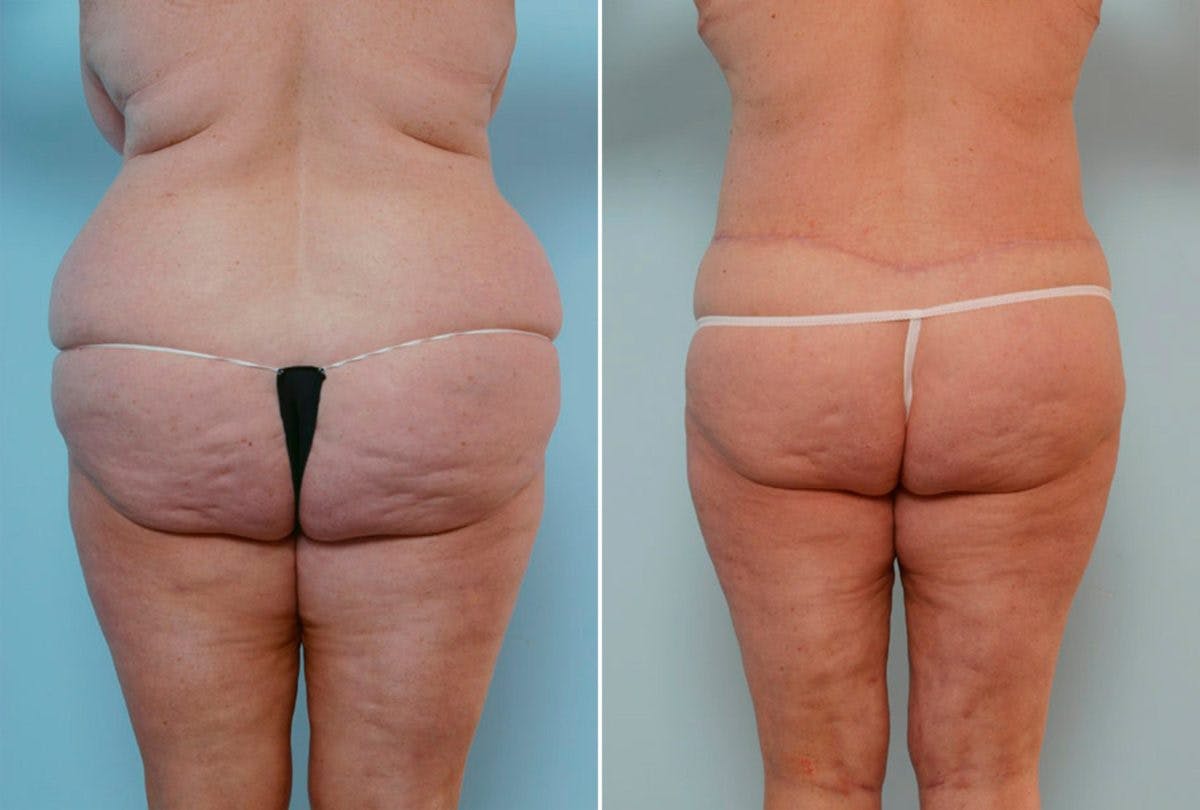 Body Lift Before & After Gallery - Patient 54881936 - Image 4