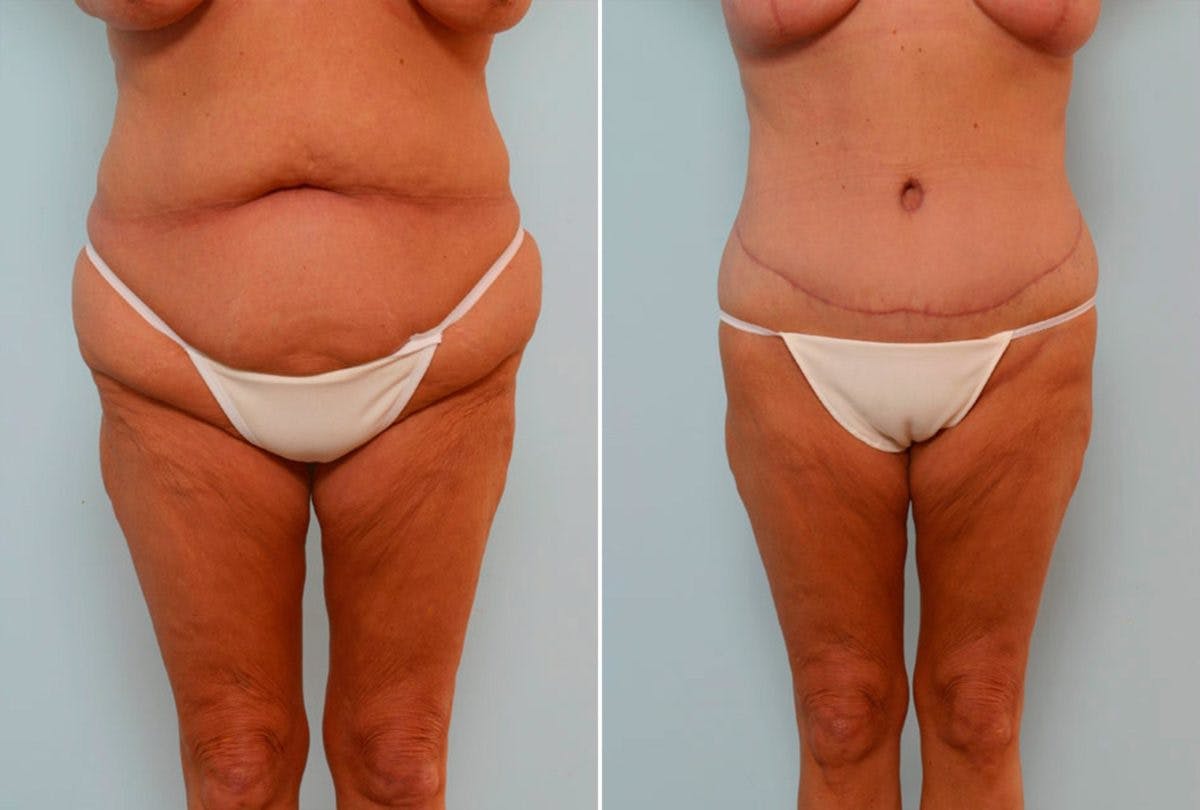 Body Lift Before & After Photo - Patient 54881942 - Image 1