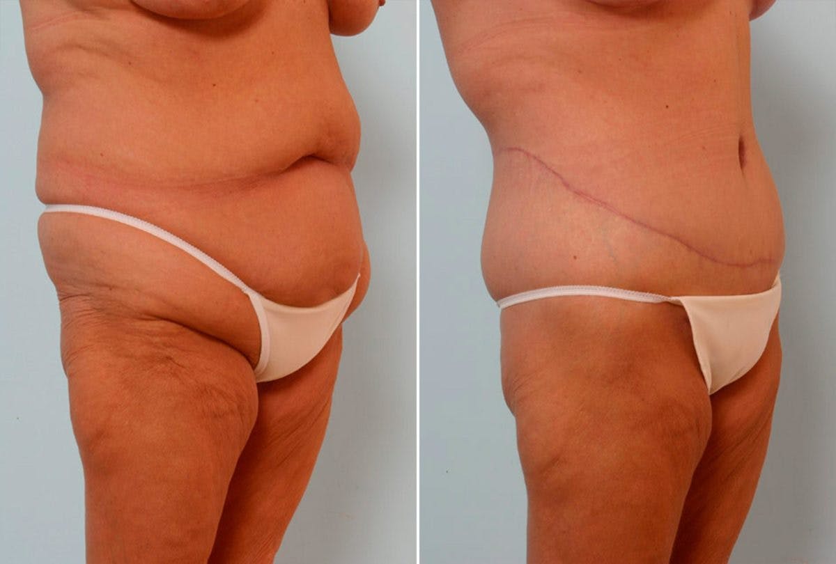 Body Lift Before & After Photo - Patient 54881942 - Image 2