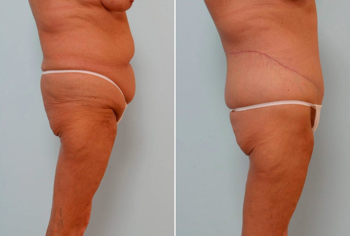 Body Lift Before & After Photo - Patient 54881942 - Image 3