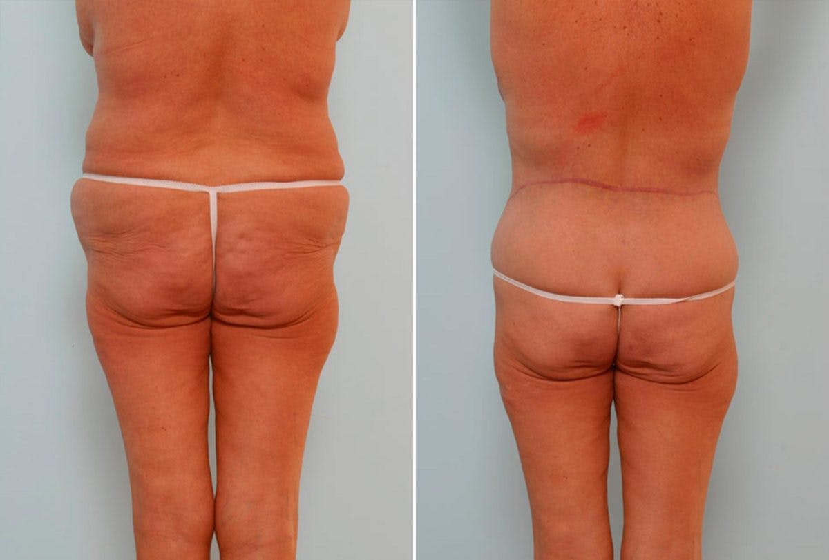 Body Lift Before & After Photo - Patient 54881942 - Image 4