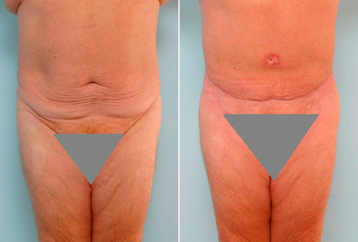 Body Lift Before & After Gallery - Patient 54881943 - Image 1