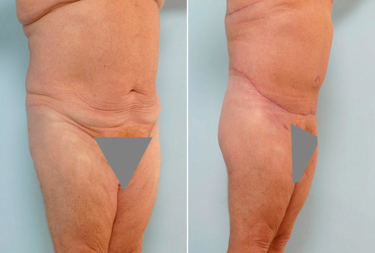 Body Lift Before & After Gallery - Patient 54881943 - Image 2