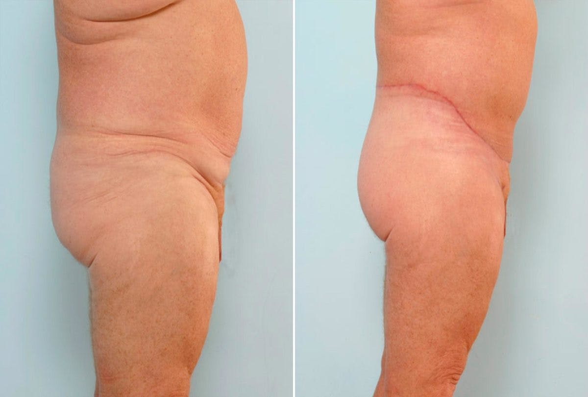 Body Lift Before & After Gallery - Patient 54881943 - Image 3