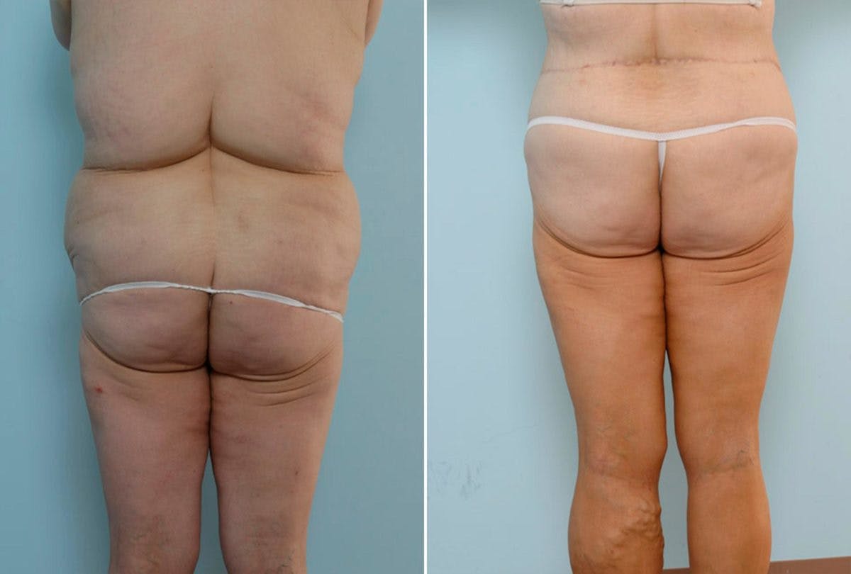 Body Lift Before & After Gallery - Patient 54881947 - Image 4