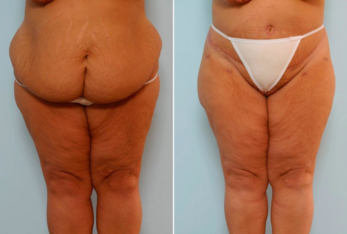 Body Lift Before & After Photo - Patient 54881948 - Image 1