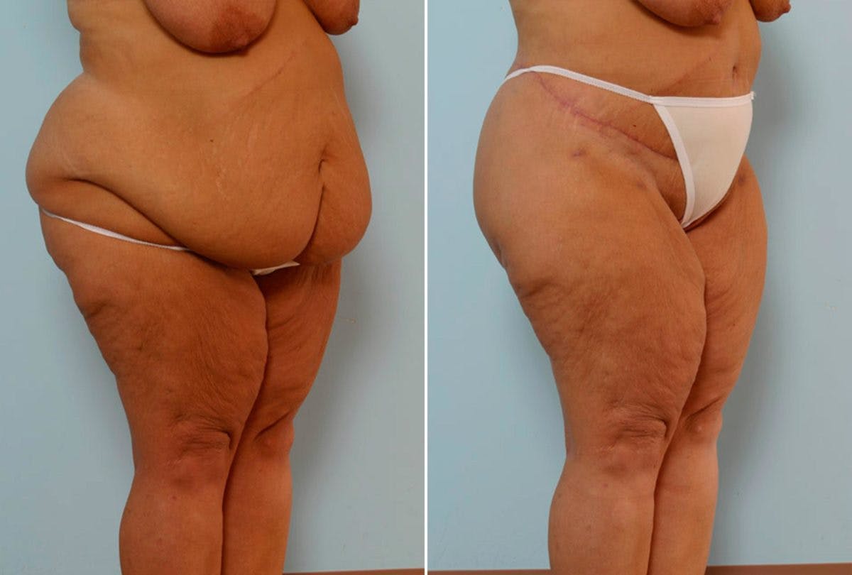 Body Lift Before & After Gallery - Patient 54881948 - Image 2