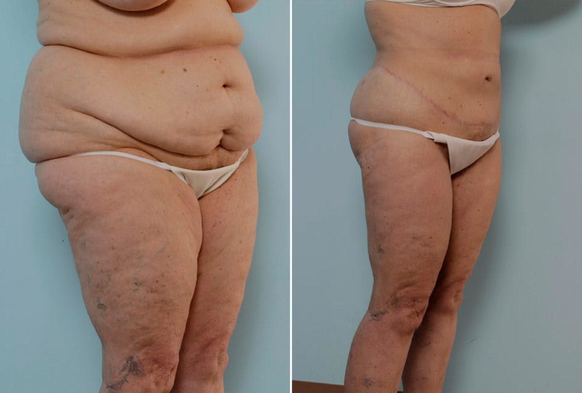 Body Lift Before & After Gallery - Patient 54881949 - Image 2