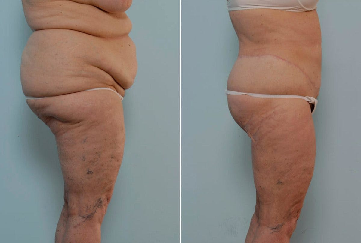 Body Lift Before & After Gallery - Patient 54881949 - Image 3