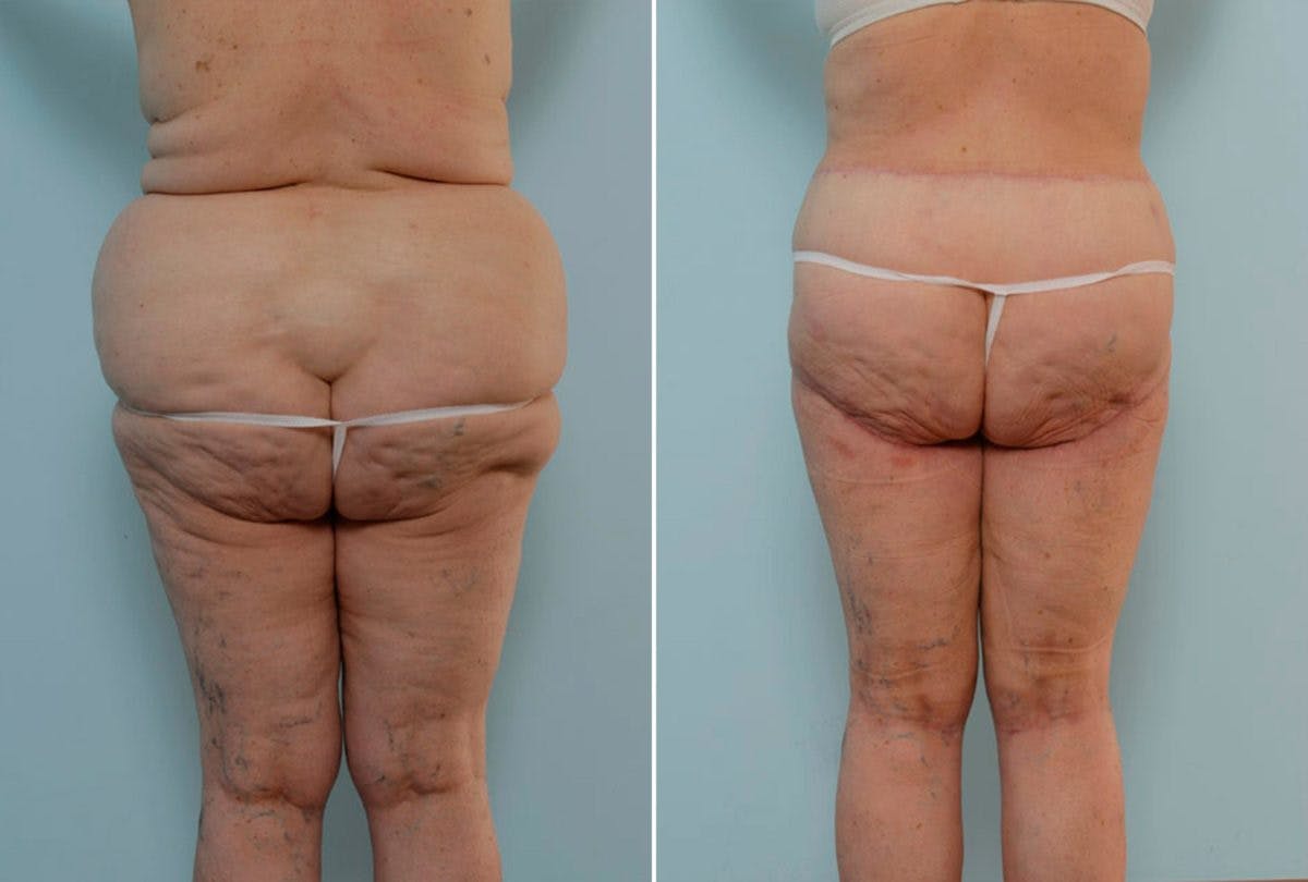 Body Lift Before & After Gallery - Patient 54881949 - Image 4