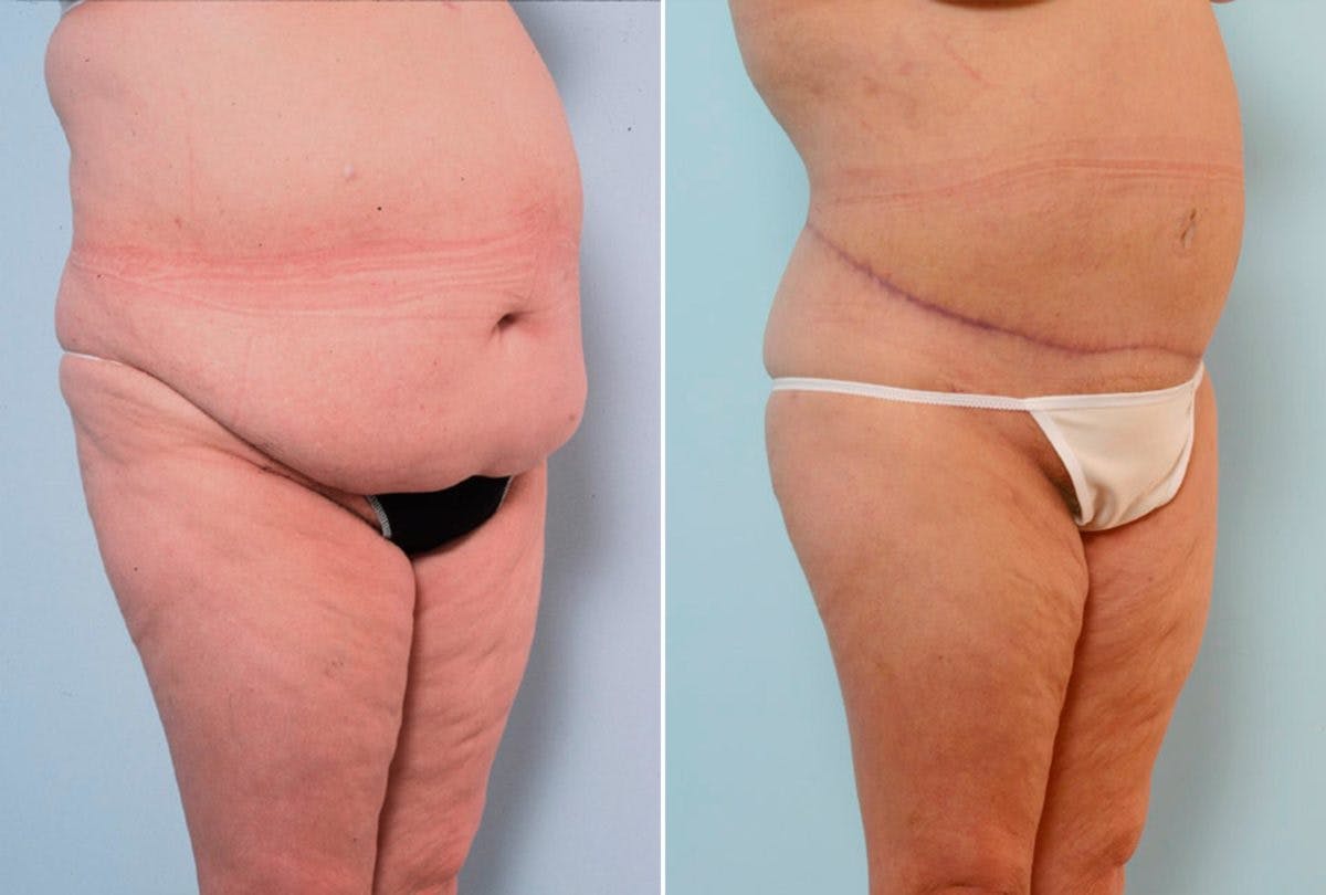 Body Lift Before & After Gallery - Patient 54881950 - Image 2