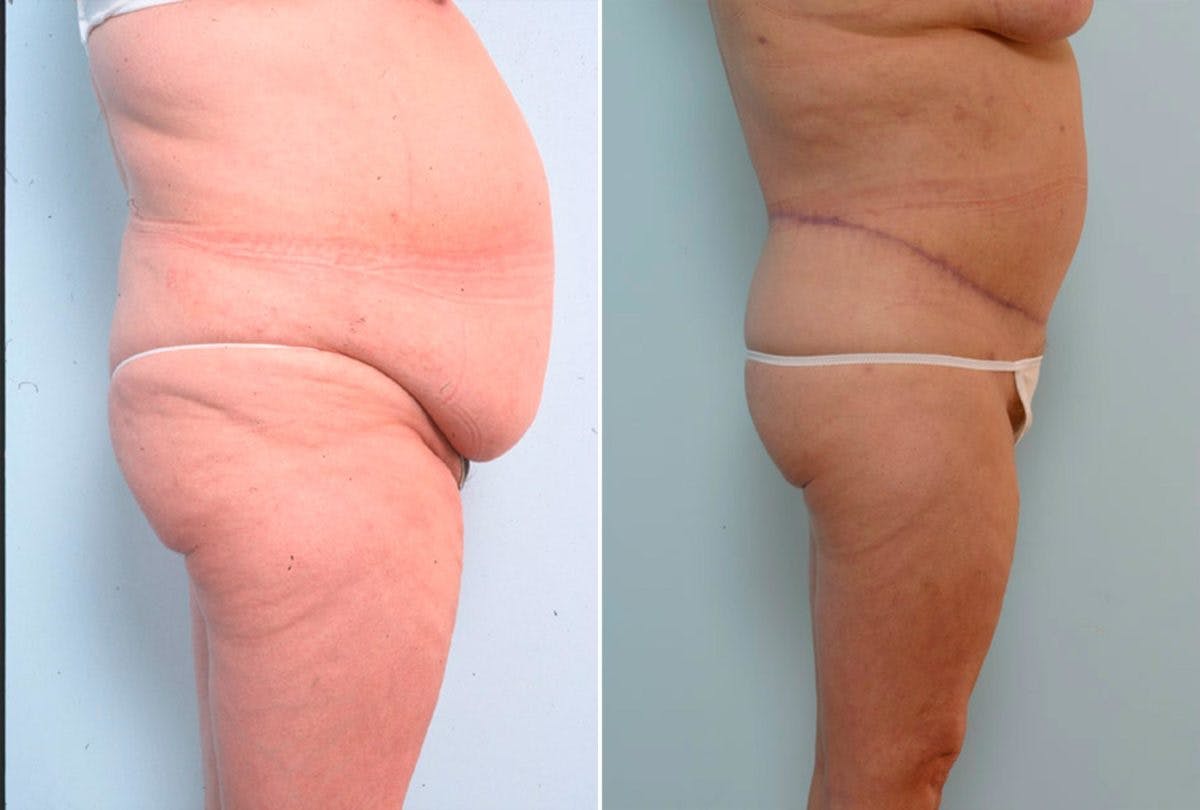 Body Lift Before & After Gallery - Patient 54881950 - Image 3