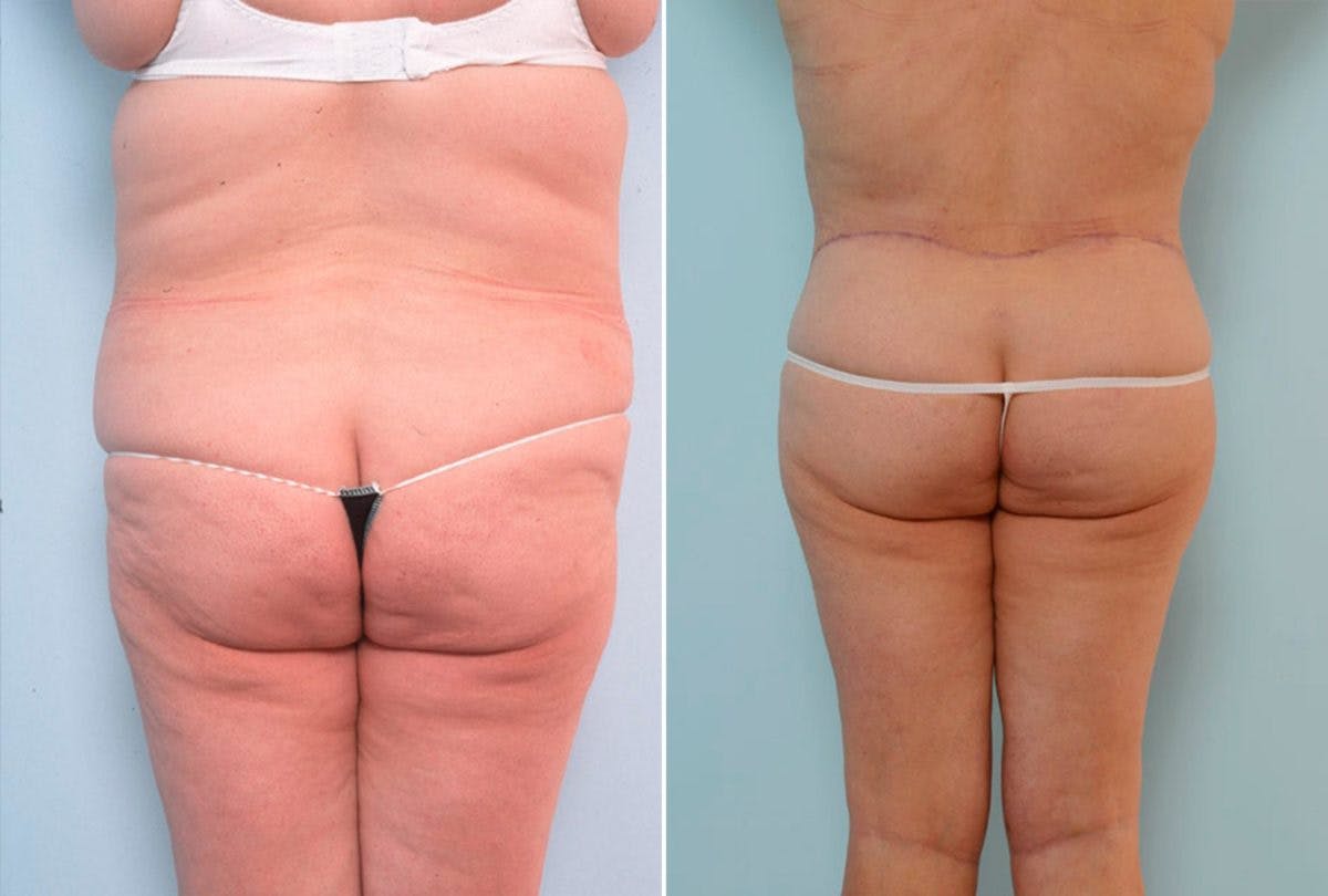 Body Lift Before & After Gallery - Patient 54881950 - Image 4