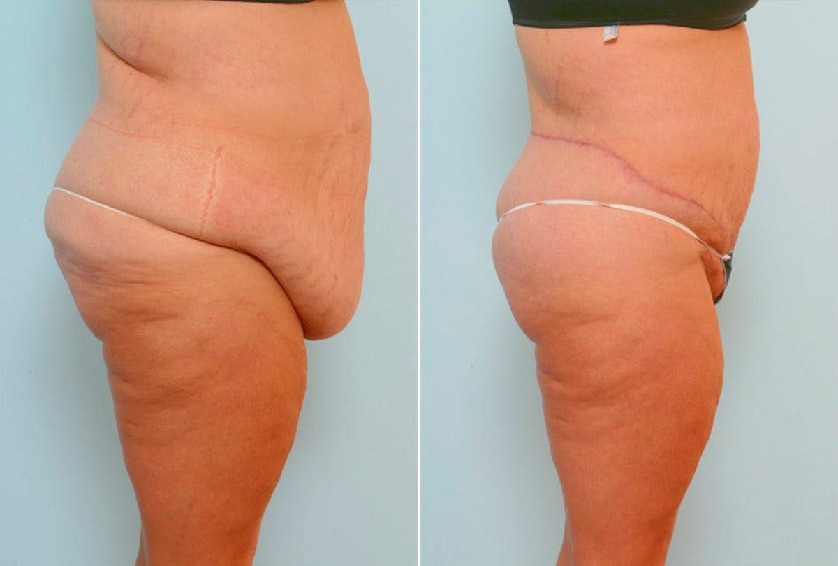 Body Lift Before & After Gallery - Patient 54881952 - Image 3