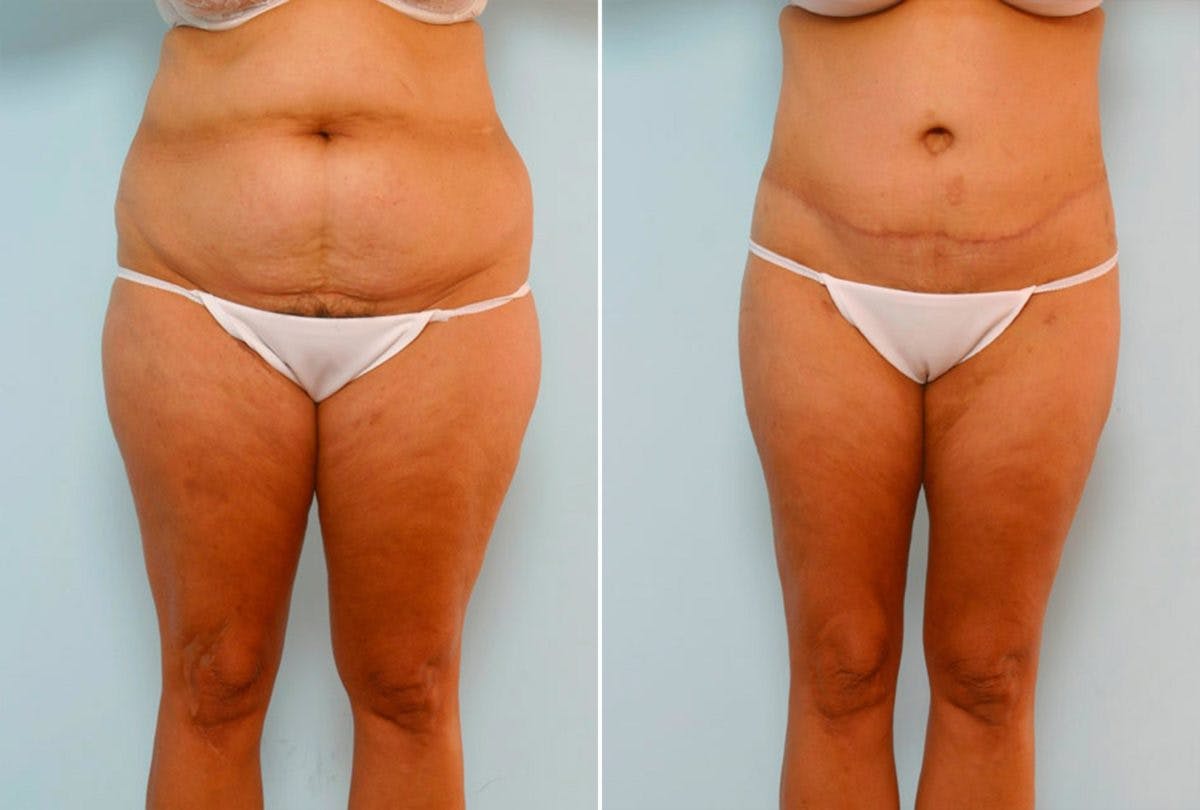 Body Lift Before & After Photo - Patient 54881953 - Image 1