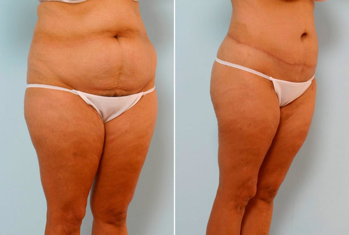 Body Lift Before & After Photo - Patient 54881953 - Image 2