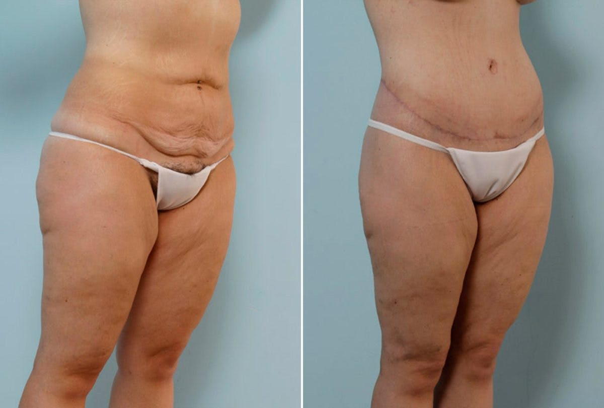 Body Lift Before & After Gallery - Patient 54881954 - Image 2