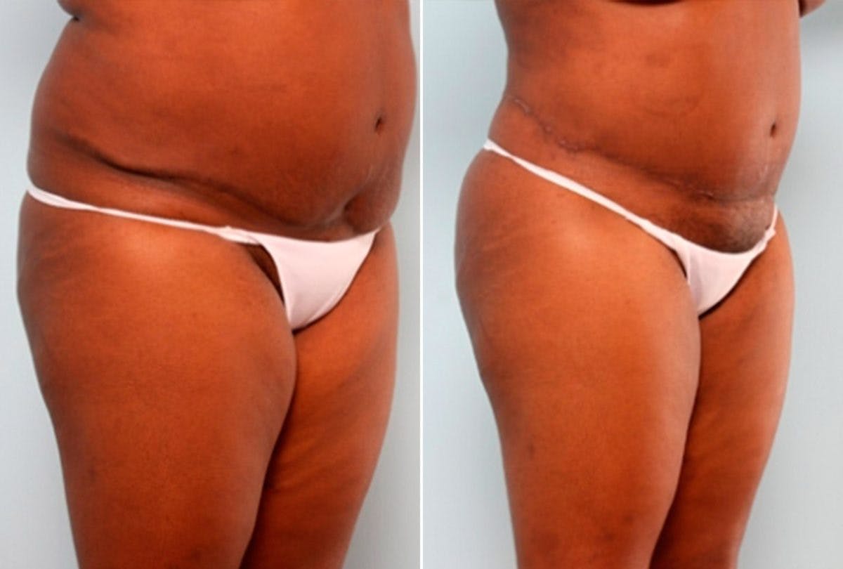 Body Lift Before & After Photo - Patient 54881960 - Image 2