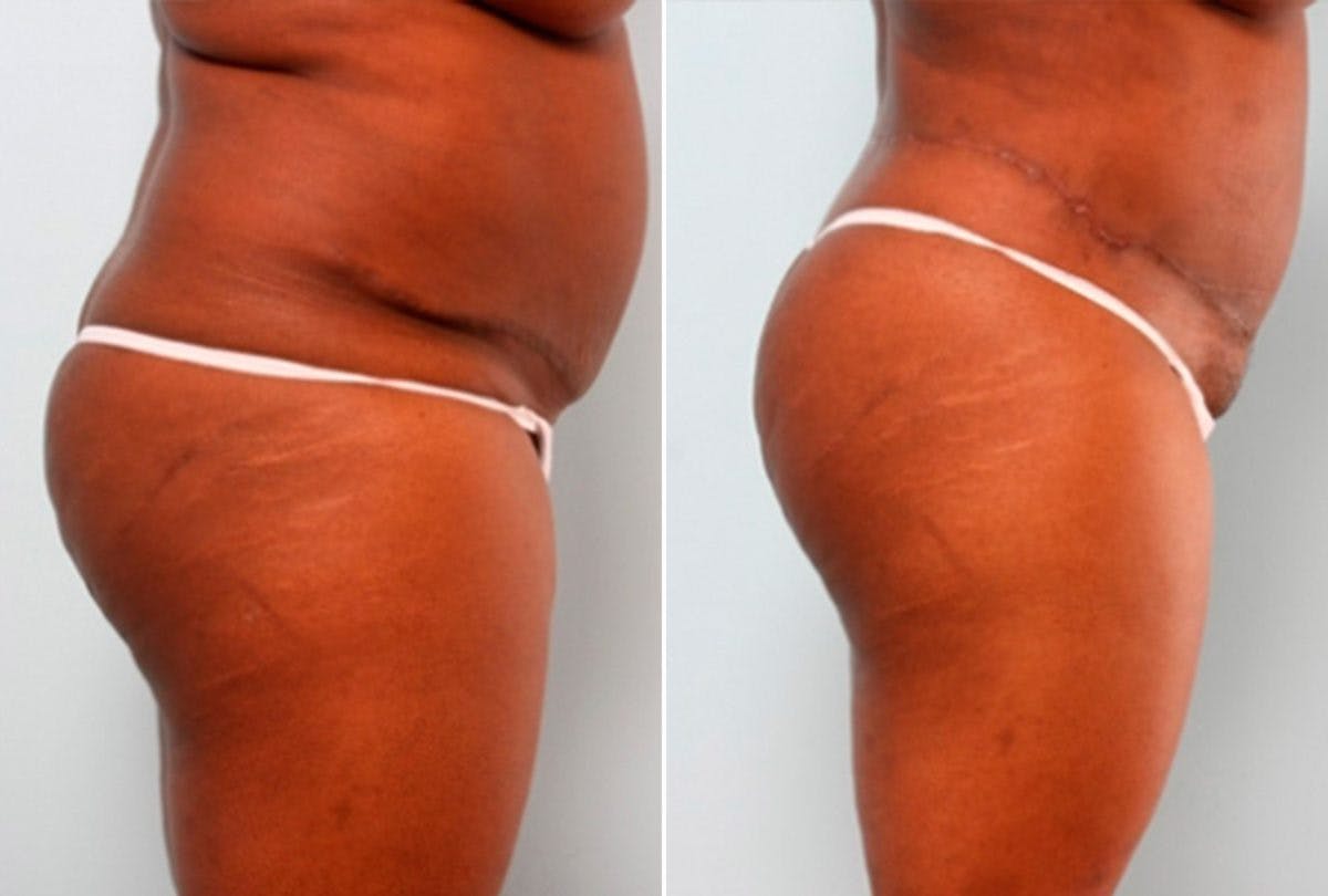 Body Lift Before & After Gallery - Patient 54881960 - Image 3