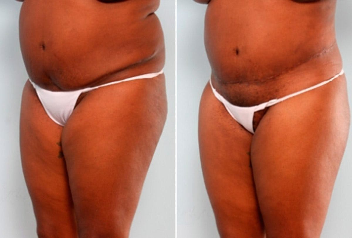 Body Lift Before & After Gallery - Patient 54881960 - Image 4