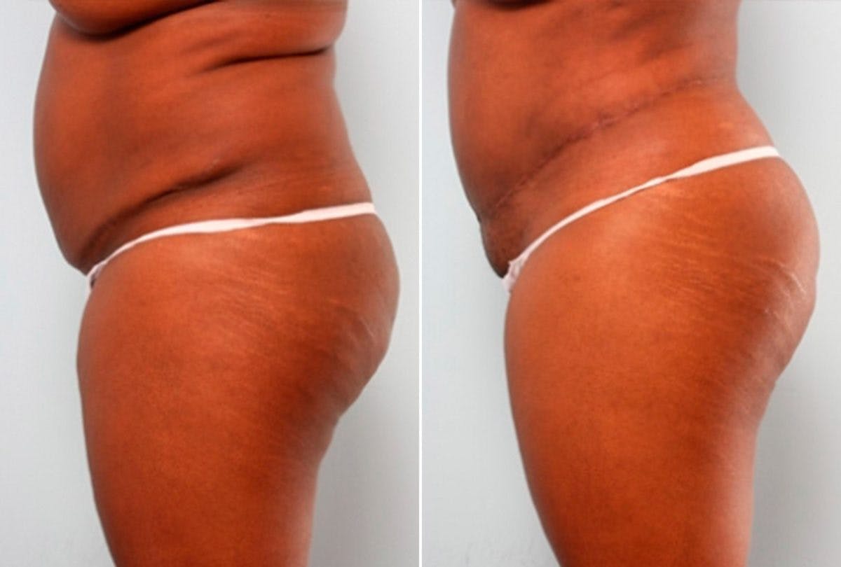Body Lift Before & After Photo - Patient 54881960 - Image 5