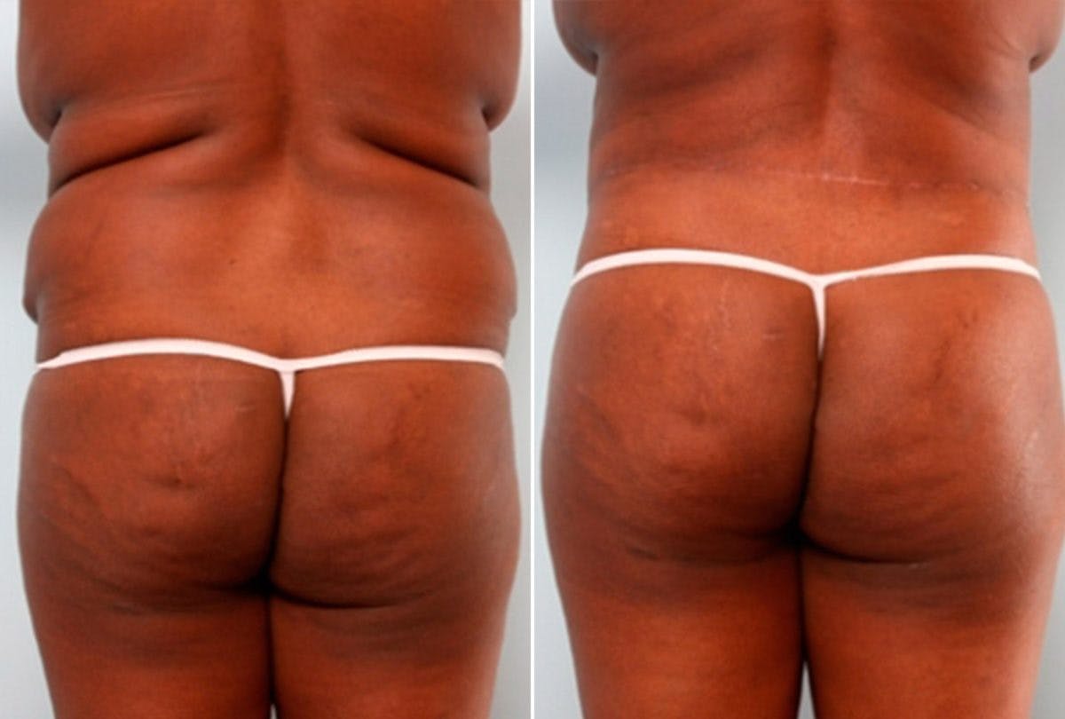 Body Lift Before & After Gallery - Patient 54881960 - Image 6