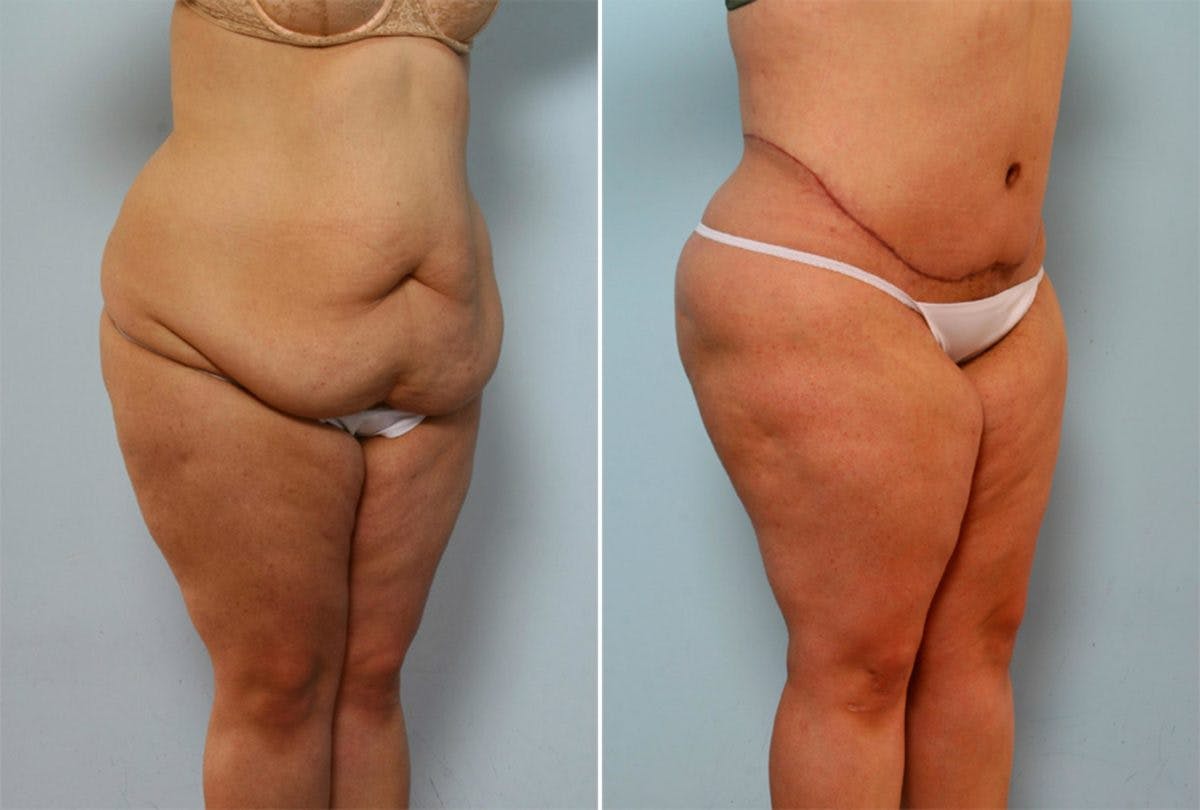 Body Lift Before & After Gallery - Patient 54881971 - Image 2