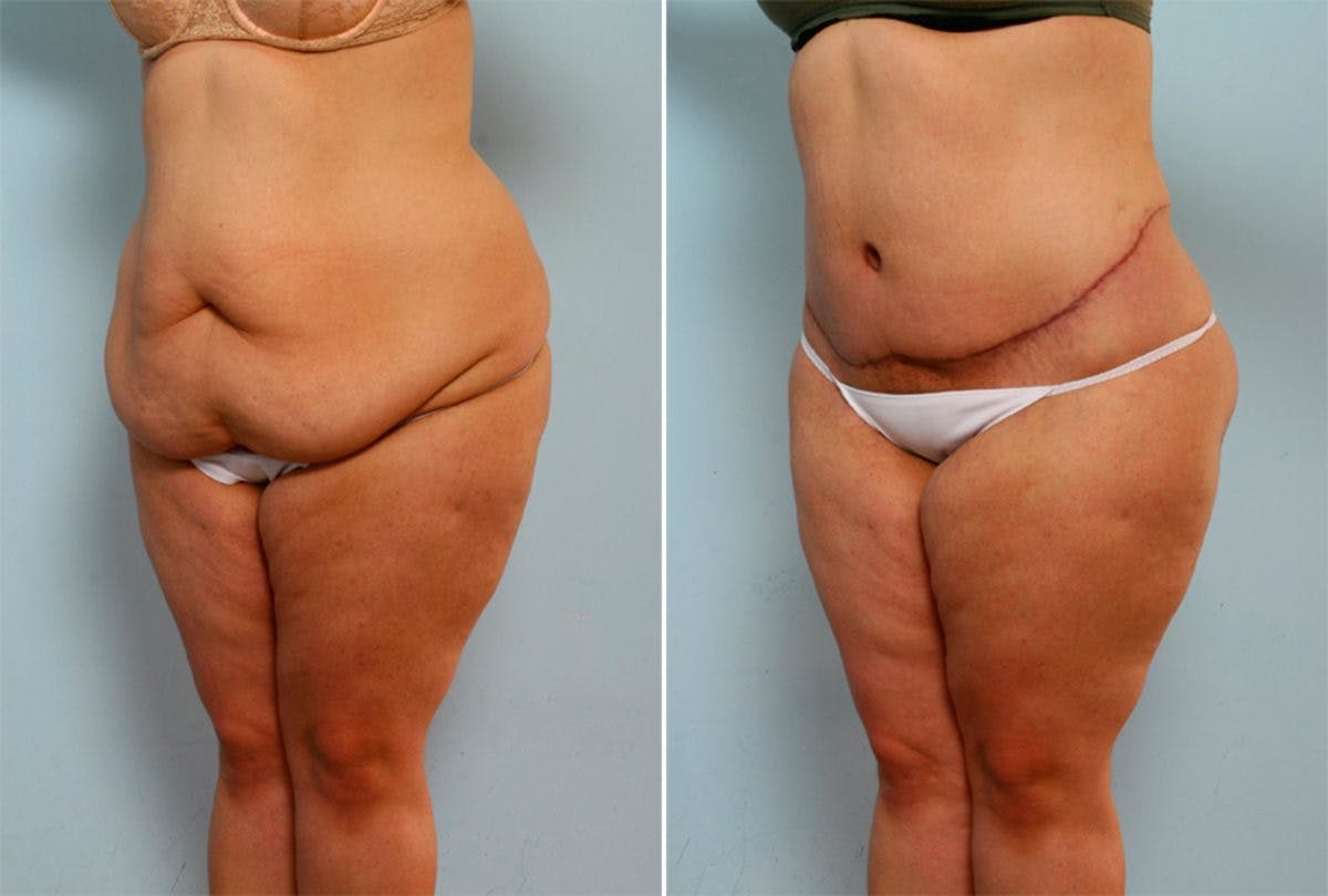 Body Lift Before & After Gallery - Patient 54881971 - Image 4