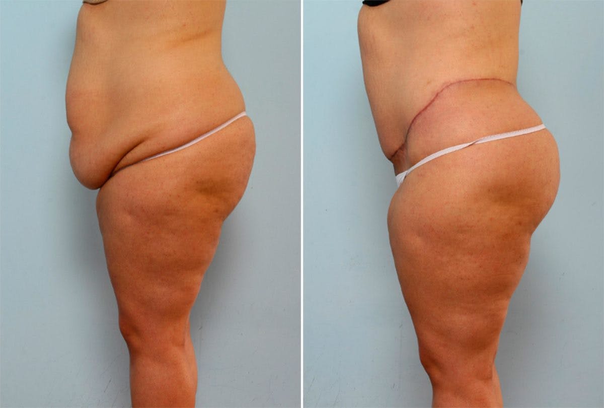 Body Lift Before & After Gallery - Patient 54881971 - Image 5