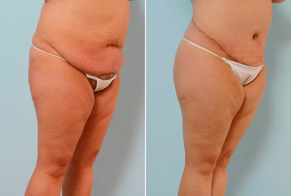 Body Lift Before & After Gallery - Patient 54881987 - Image 2