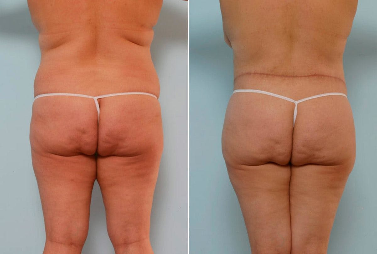 Body Lift Before & After Photo - Patient 54881987 - Image 4