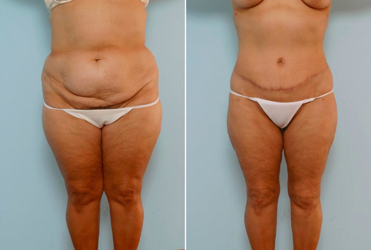 Body Lift Before & After Gallery - Patient 54881997 - Image 1