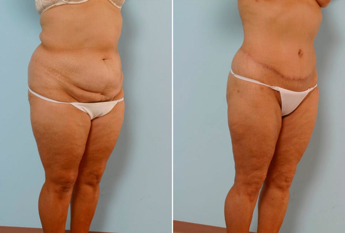 Body Lift Before & After Gallery - Patient 54881997 - Image 2