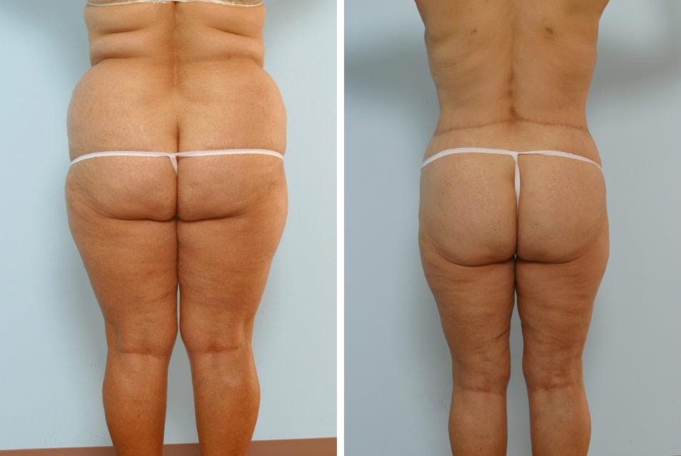 Body Lift Before & After Gallery - Patient 54881997 - Image 4