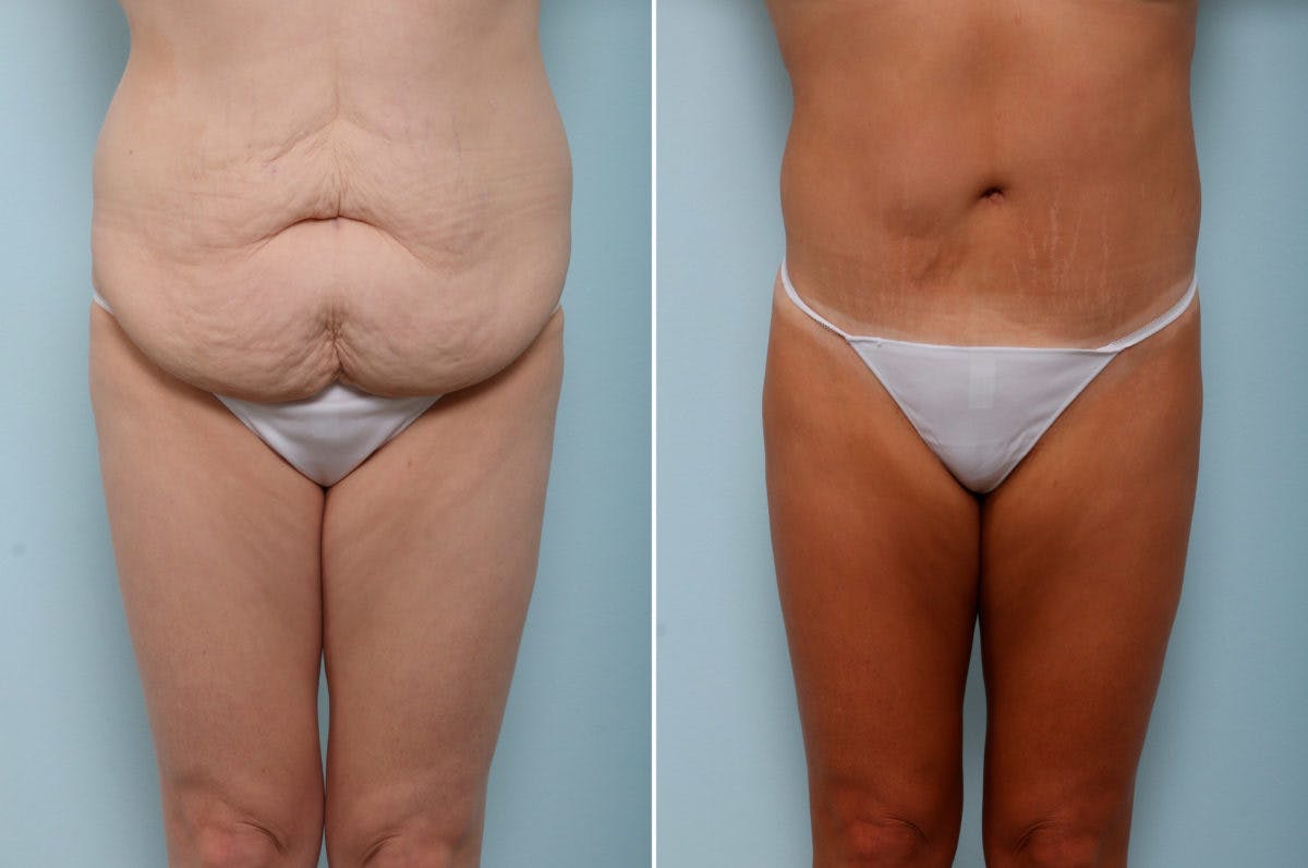 Body Lift Before & After Photo - Patient 54882022 - Image 1