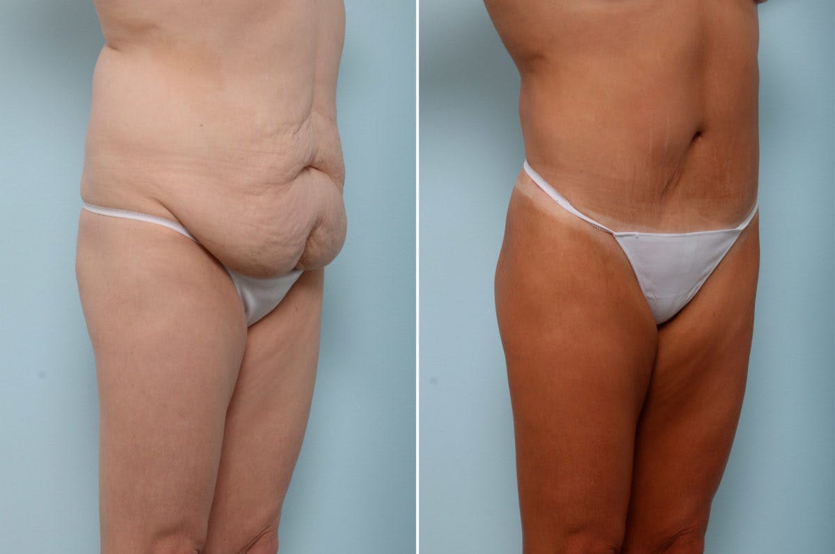 Body Lift Before & After Gallery - Patient 54882022 - Image 2
