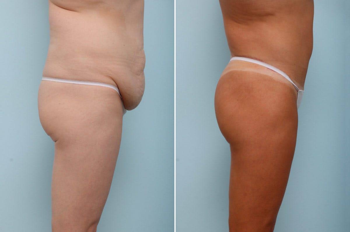 Body Lift Before & After Gallery - Patient 54882022 - Image 3