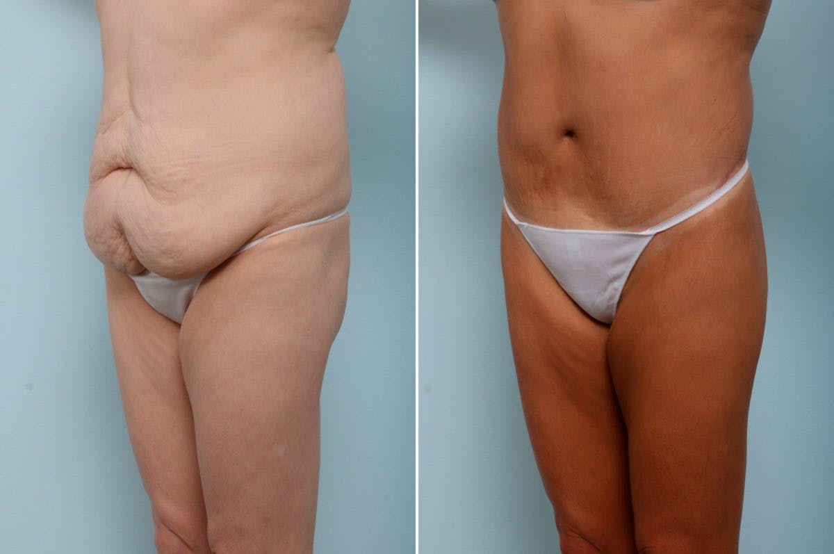 Body Lift Before & After Photo - Patient 54882022 - Image 4