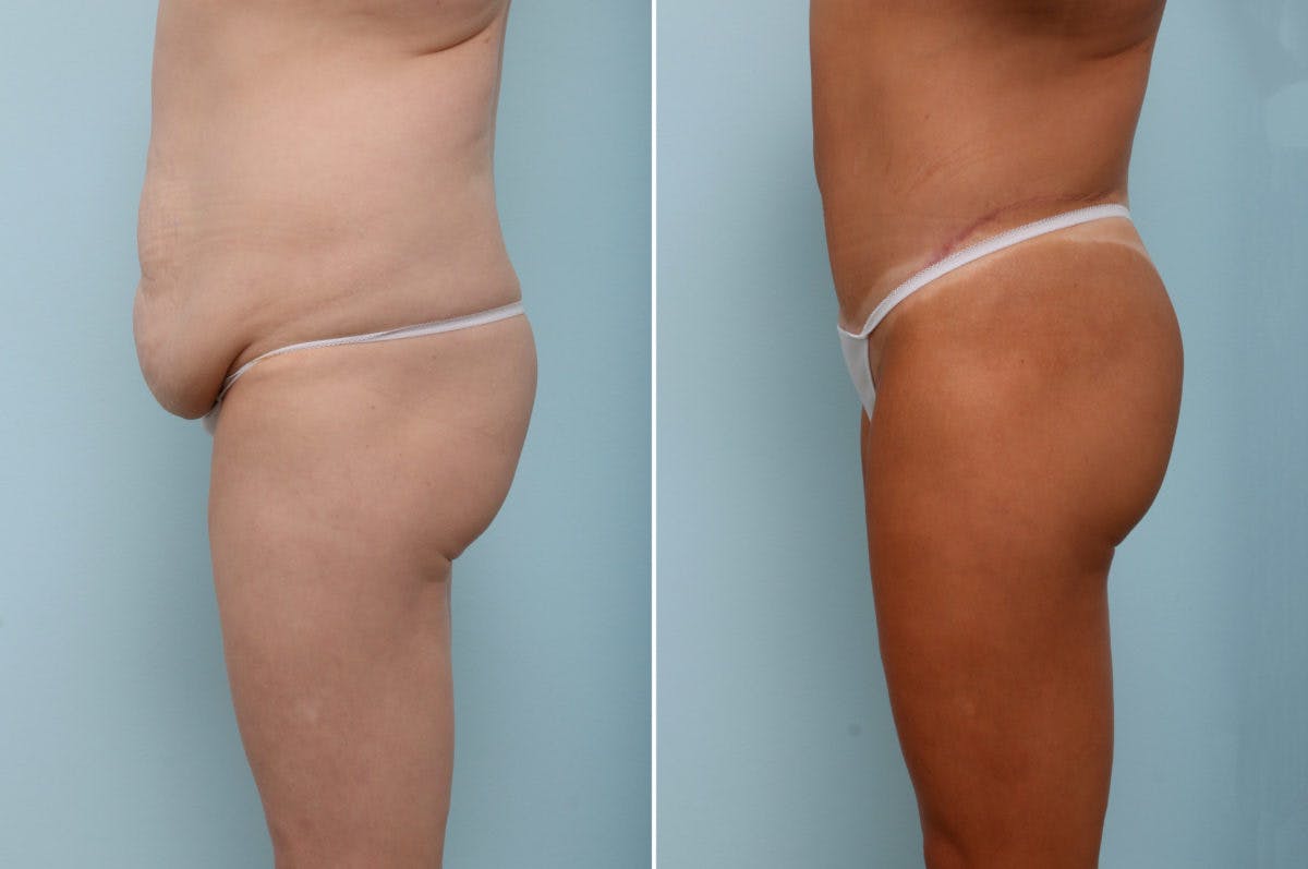 Body Lift Before & After Gallery - Patient 54882022 - Image 5