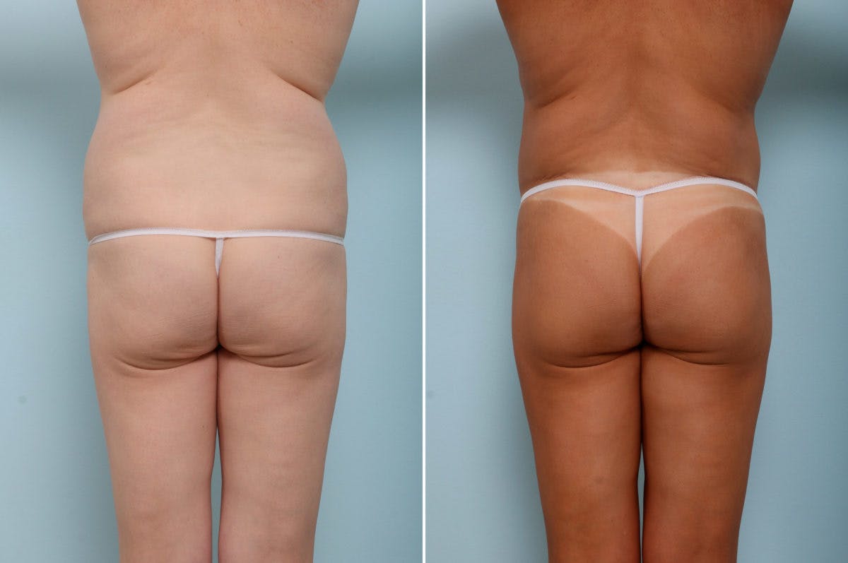 Body Lift Before & After Photo - Patient 54882022 - Image 6