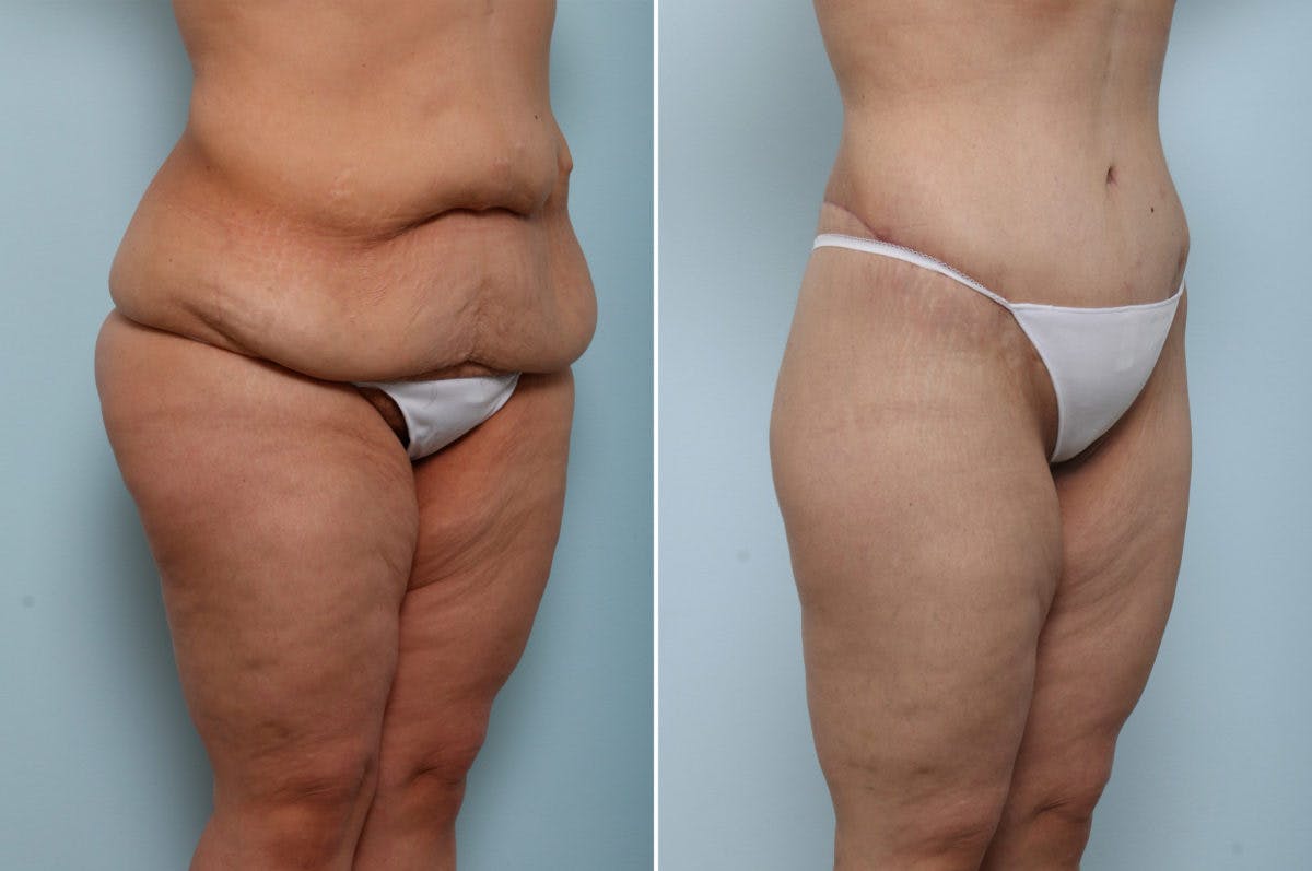 Body Lift Before & After Gallery - Patient 54882035 - Image 2