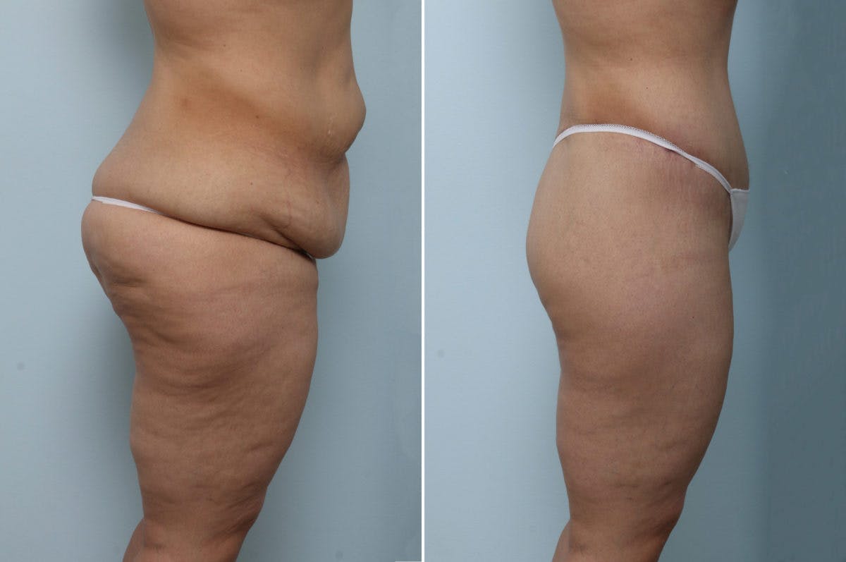 Body Lift Before & After Gallery - Patient 54882035 - Image 3