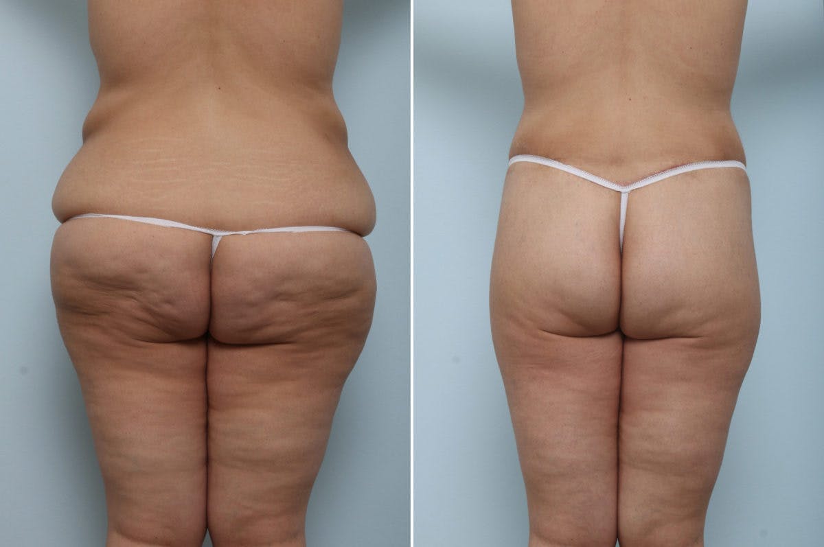 Body Lift Before & After Gallery - Patient 54882035 - Image 6